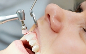 Tooth Stone Cleaning Important?